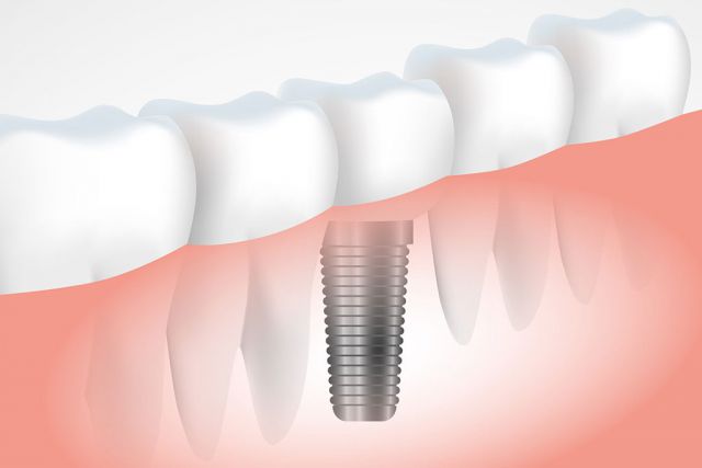 Stanco di dover combattere ogni giorno con ponti e dentiere? Scegli l&#039;implantologia