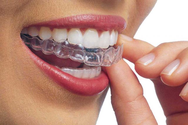 Invisalign